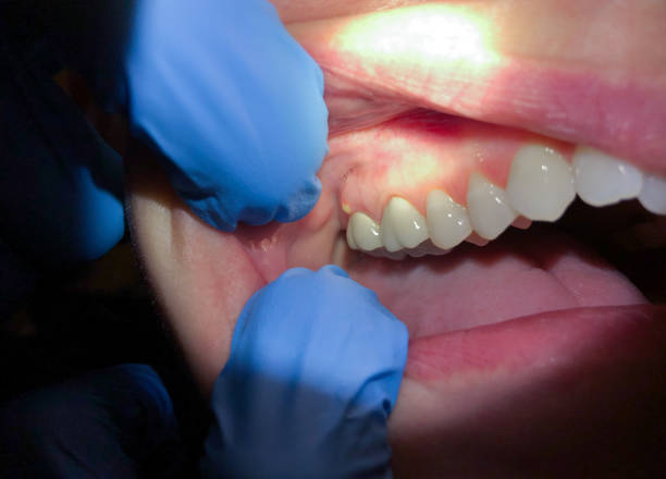 Best Emergency Tooth Extraction in Harriman, TN